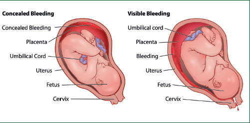 Antepartum Haemorrhage and Placental Disorders During Pregnancy